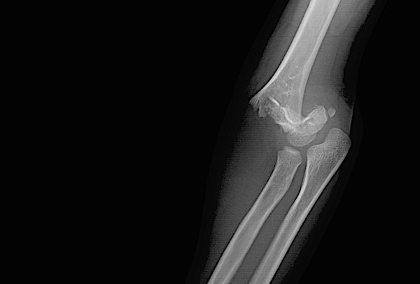 Hình ảnh tin tức Cảnh báo đối với sản phẩm dinh dưỡng công thức dành cho trẻ nhỏ nhiễm Cronobacter sakazakii và Salmonella Newport đã được nhập khẩu về Việt Nam